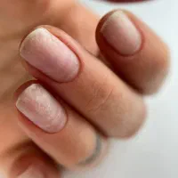 کاشت و ترمیم ناخن