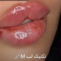 فیلر نورامیس اصل  فقط ۹۵۰ نمایندگی نورامیس