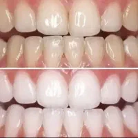 سفید کننده فوری دندان|آرایشی، بهداشتی، درمانی|زرندیه, |دیوار