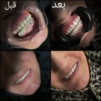 دندان مصنوعی،روکش،ایمپلنت دندانپزشکی دکتر نقوی