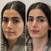 مدل کاملا رایگان فیلر ژل زیبایی