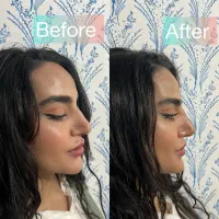 تخفیفات ۵۰ درصدی ژل ،آنزیم بینی ، بوتاکس ، پاکسازی|خدمات آرایشگری و زیبایی|کرمانشاه, |دیوار