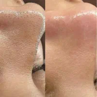 آف فیشال و ریموو