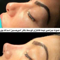 جراحی بینی|خدمات آرایشگری و زیبایی|ساری, |دیوار