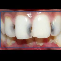 عصبکشی اندو دندان جلو۱۲۳تعرفه دولتی