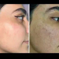 کرم vip سفید کننده قطعی . ضد جوش و منافذ