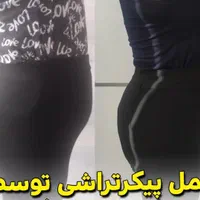 ساکشن شکم .غبغب .تزریق چربی .فیلر.پهلوتوسط پزشک|خدمات آرایشگری و زیبایی|کرمانشاه, |دیوار