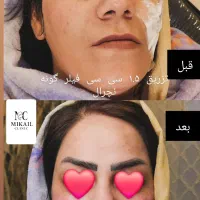 چهره‌ای که عاشقش میشی،بوتاکس،ژل وفیلر توسط متخصص|خدمات آرایشگری و زیبایی|ارومیه, |دیوار