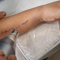 پاک کردن تاتو بدون درد با دستگاه کیوسوئیچ پیکوسکند|خدمات آرایشگری و زیبایی|ساری, |دیوار