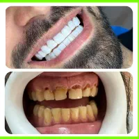 دندانپزشکی عصبکشی/کامپوزیت/پالیش/ترمیم/شرق و غرب|خدمات زیبایی و سلامت|تهران, تهرانپارس شرقی|دیوار