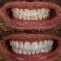 خدمات دندانپزشکی کامپوزیت لمینت عصب کشی|خدمات آرایشگری و زیبایی|تهران, تهرانپارس غربی|دیوار
