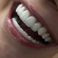 کامپوزیت( اقساط شیش ماهه/از دم قسط)روکش و عصبکشی