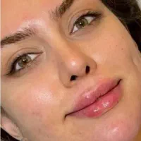 تخفیف.ژل بوتاکس مزو آنزیم آموزش کامل