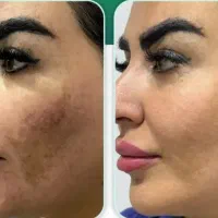 مزونیدلینگ صورت