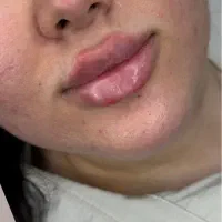 ژل بوتاکس ژل لب فیلرزیر چشم مزوتراپی مزوژل|خدمات آرایشگری و زیبایی|شیراز, کاراندیش|دیوار