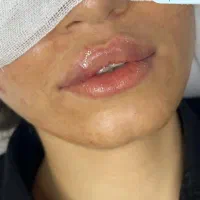 مدل فیلر و بوتاکس