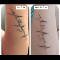 ۴۰٪ تخفیف پاک کردن تتو و خالکوبی با لیزرQ-switch|خدمات آرایشگری و زیبایی|کرمانشاه, |دیوار