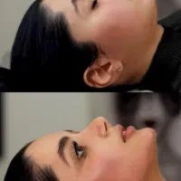 اموزش و انجام خدمات ژل بوتاکس فیلر پی ار پی مزو ژل