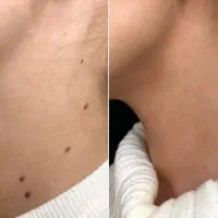 حذف خال، کک و مک و زوائد پوستی با کمترین قیمت|خدمات آرایشگری و زیبایی|یاسوج, |دیوار