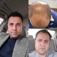کاشت مو و ابرو بدون پیش پرداخت با چک و حتی سفته|خدمات آرایشگری و زیبایی|مشهد, وکیل‌آباد|دیوار