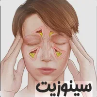 سینوزیت و تخلیه بدون جراحی