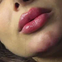 ژل بوتاکس