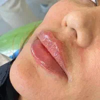 تزریقات ژل و بوتاکس و نخ