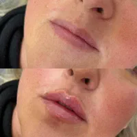 خدمات زیبایی صورت مزوتراپی بوتاکس فیلر|خدمات آرایشگری و زیبایی|شهریار, شهریار|دیوار