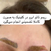 پاک کردن تاتو با دستگاه لیزر