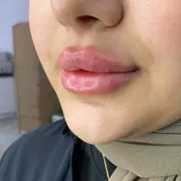 ژل بوتاکس ژل لب فیلرزیر چشم مزوتراپی مزوژل|خدمات آرایشگری و زیبایی|شیراز, کاراندیش|دیوار
