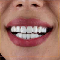 دندانپزشکی کامپوزیت با آفر ویژه تا ده روز اینده|خدمات آرایشگری و زیبایی|ارومیه, |دیوار