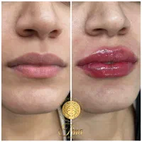 تخفیف ویژه بوتاکس وانواع فیلر