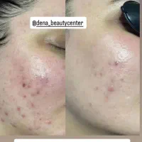 خدمات فیشال وتتو (درمان پوست شما)