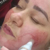 تخفیف ویژه میکروبلیدینگ و مزونیدلینگ، ریموو، پلکسر|خدمات زیبایی و سلامت|تهران, چهارصد دستگاه|دیوار