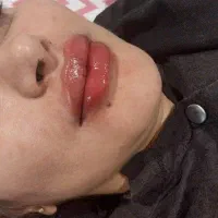 تزریق فیلر و بوتاکس لیفت نخ مزو و...|خدمات آرایشگری و زیبایی|مشهد, گلشور|دیوار