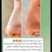 کرم لیفتینگ بینی|آرایشی، بهداشتی، درمانی|رشت, پل تالشان|دیوار