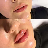 تخ*فیف ویژه خدمات زیبایی فیلر بوتاکس هایفوتراپی|خدمات آرایشگری و زیبایی|بوشهر, |دیوار