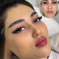 تزریق چربی، ژل وبوتاکس ومادلینگ صورت توسط پزشک|خدمات آرایشگری و زیبایی|کرمانشاه, |دیوار