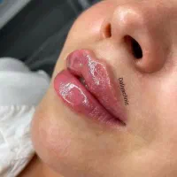 تزریق ژل (فیلر)و بوتاکس و لیفت بانخ ومادلینگ صورت|خدمات آرایشگری و زیبایی|تهران, هفت حوض|دیوار
