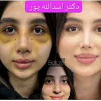 جراحی بینی با قیمت عالی دکتراسدالله پور29میلیون500