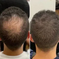 پرپشتی دیگه حسرت نیست