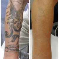 ریمو و پاک کردن تتو با لیزر/روشن سازی/بوتاکس