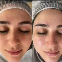 پاکسازی صورت فقط ۲۵۰ هزار