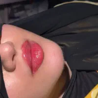 ژل و بوتاکس