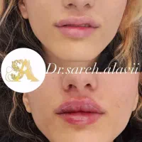 جشنواره تخفیف تزریق فیلر لب به مدت محدود توسط پزشک|خدمات آرایشگری و زیبایی|قم, دورشهر|دیوار