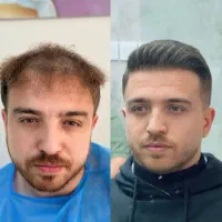 کاشت مو و ابرو|خدمات آرایشگری و زیبایی|بوشهر, |دیوار