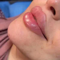 تخفیف بوتاکس وفیلر
