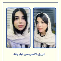 فیلر لب روسی -زاویه سازی -بوتاکس-پی ار پی -مزو|خدمات آرایشگری و زیبایی|تهران, دریا|دیوار