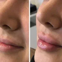 تزریق ژل و بوتاکس تضمینی|خدمات آرایشگری و زیبایی|اهواز, نادری|دیوار