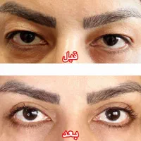 عمل پلک بالا بلفاروپلاستی|خدمات آرایشگری و زیبایی|شیراز, ملاصدرا|دیوار